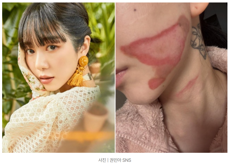 AOA 권민아 리프팅 시술 안면 화상 