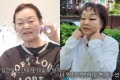 이혜정, 실→콜라겐 넣고 스킨 보톡스까지‥시술 후 비포 애프터