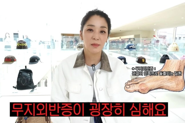 '7년째 백수' 한고은 남편, 무지외반증 말기였다