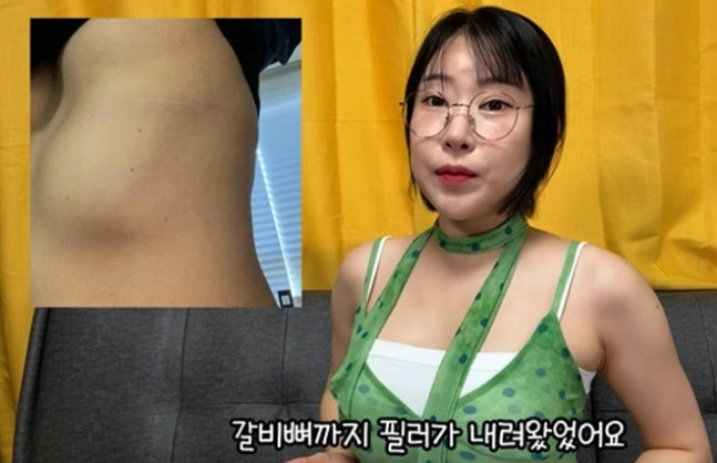"가슴이 4개가 됐다" 이세영, 필러 부작용 사진 첫 공개 '충격'